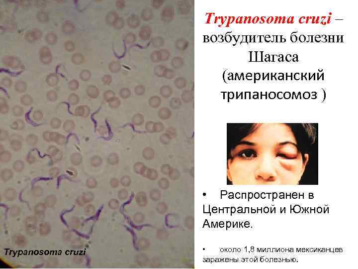 Лечение опоясывающего герпеса у взрослых